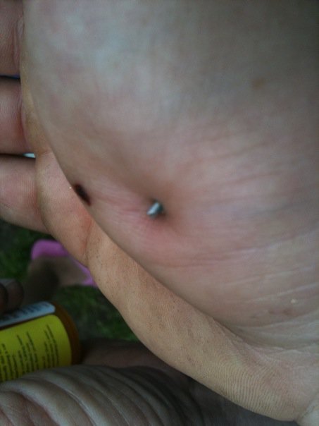 wound2.jpg