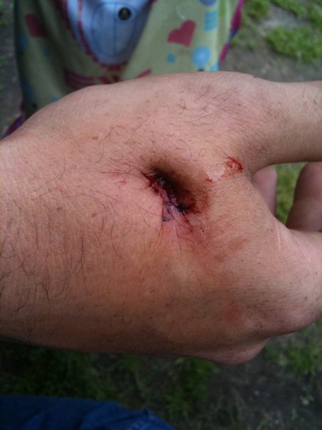 wound.jpg
